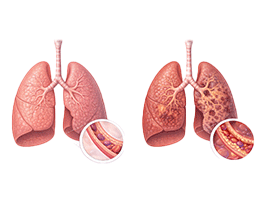 만성폐쇄성폐질환