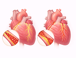 허혈성심장질환