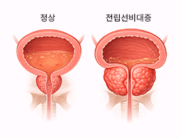 전립선비대증